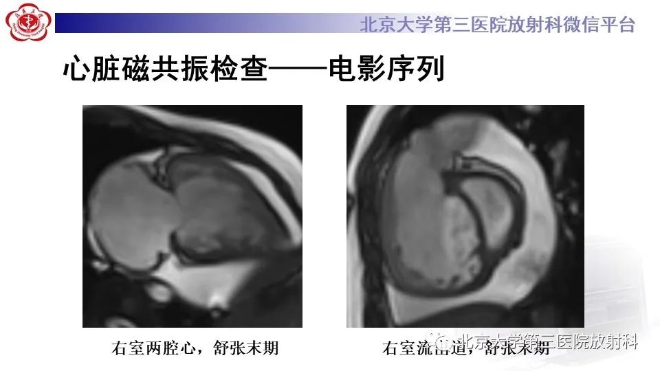 影像PPT - 【PPT】肺动脉高压的影像评估-6