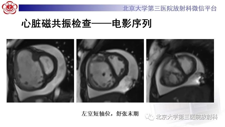 影像PPT - 【PPT】肺动脉高压的影像评估-7