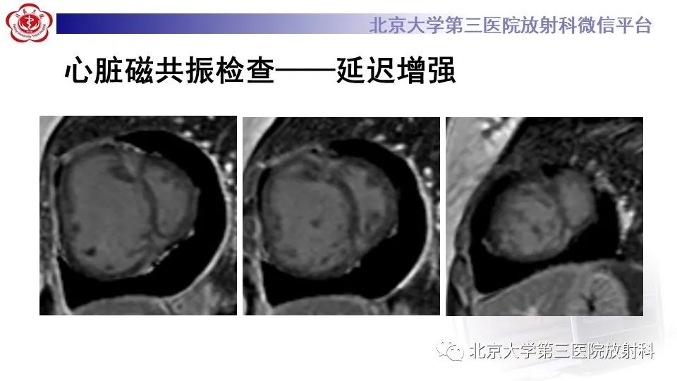 影像PPT - 【PPT】肺动脉高压的影像评估-8