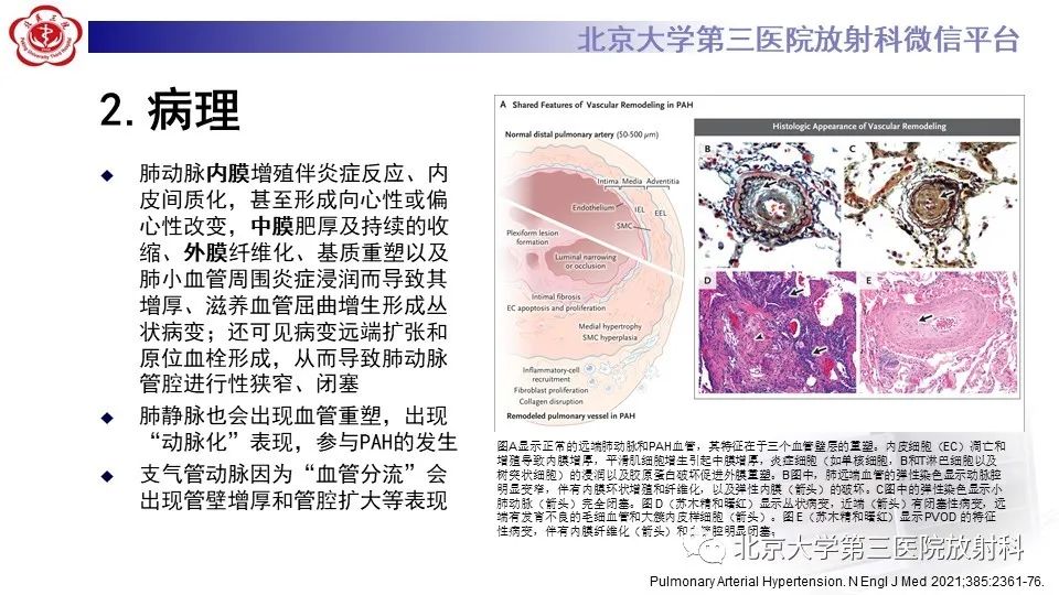 影像PPT - 【PPT】肺动脉高压的影像评估-17