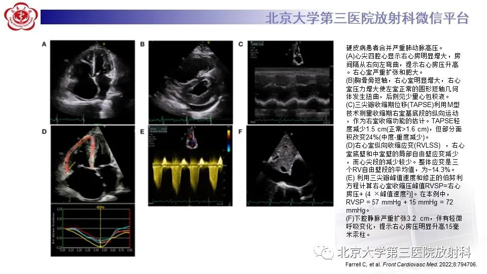 影像PPT - 【PPT】肺动脉高压的影像评估-21