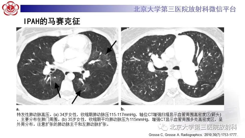 影像PPT - 【PPT】肺动脉高压的影像评估-24