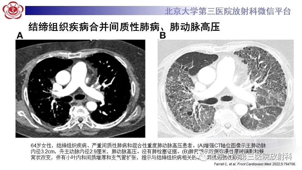 影像PPT - 【PPT】肺动脉高压的影像评估-25