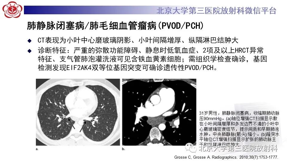 影像PPT - 【PPT】肺动脉高压的影像评估-26