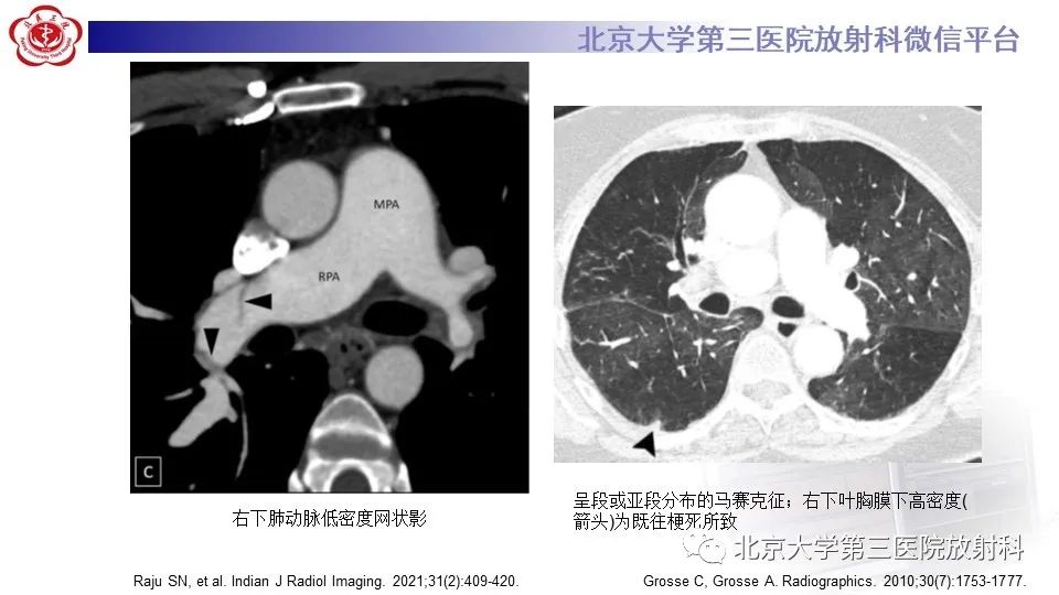 影像PPT - 【PPT】肺动脉高压的影像评估-28