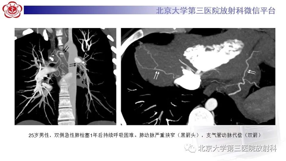 影像PPT - 【PPT】肺动脉高压的影像评估-29