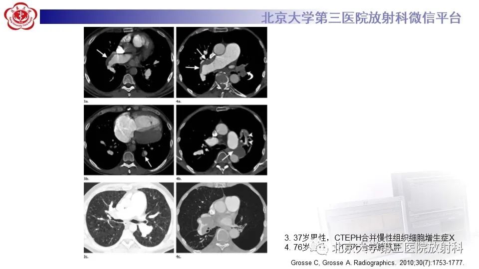 影像PPT - 【PPT】肺动脉高压的影像评估-30