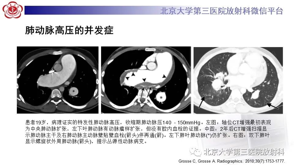 影像PPT - 【PPT】肺动脉高压的影像评估-31