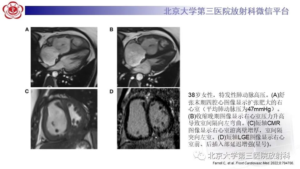 影像PPT - 【PPT】肺动脉高压的影像评估-33