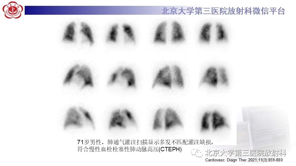 影像PPT - 【PPT】肺动脉高压的影像评估-35
