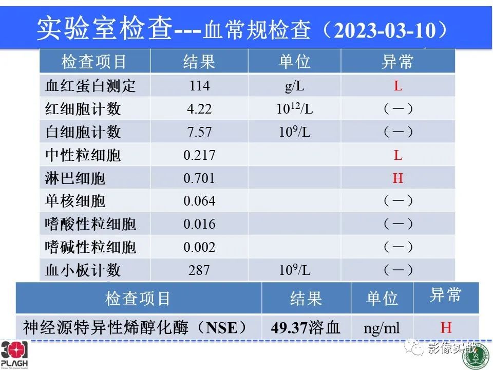 影像PPT - 【病例】视网膜母细胞瘤1例MR影像-4