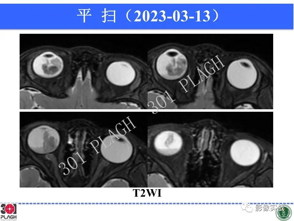影像PPT - 【病例】视网膜母细胞瘤1例MR影像-5