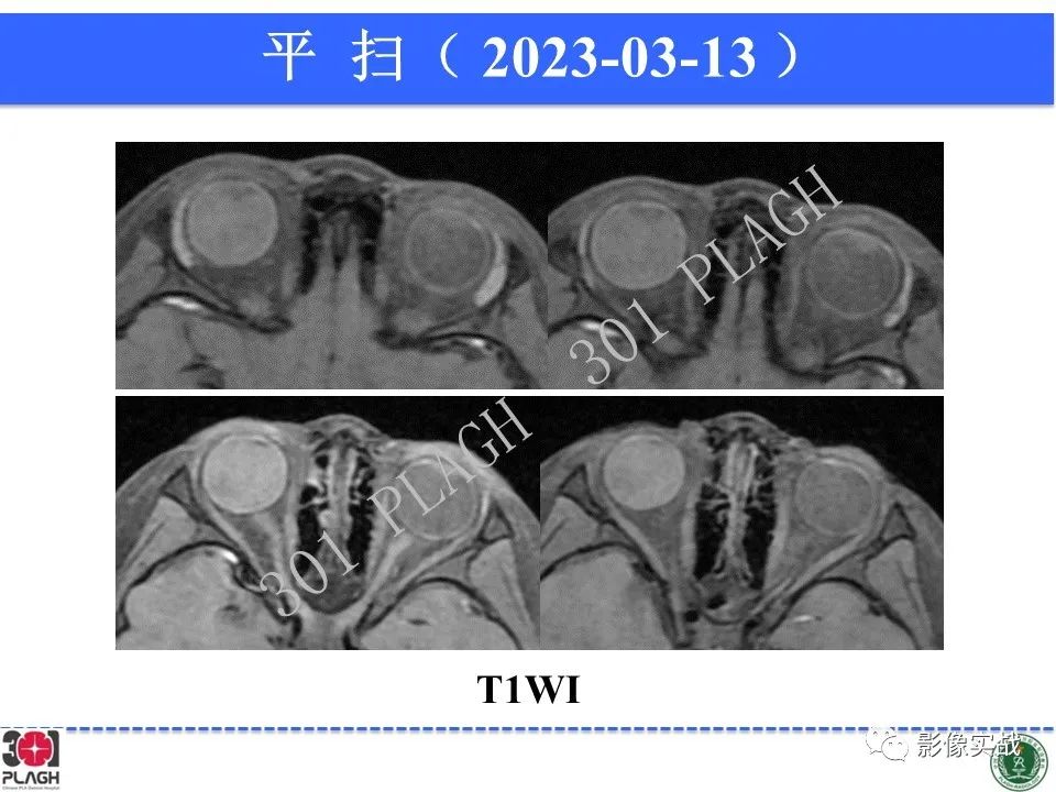 影像PPT - 【病例】视网膜母细胞瘤1例MR影像-6