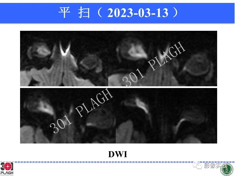 影像PPT - 【病例】视网膜母细胞瘤1例MR影像-7