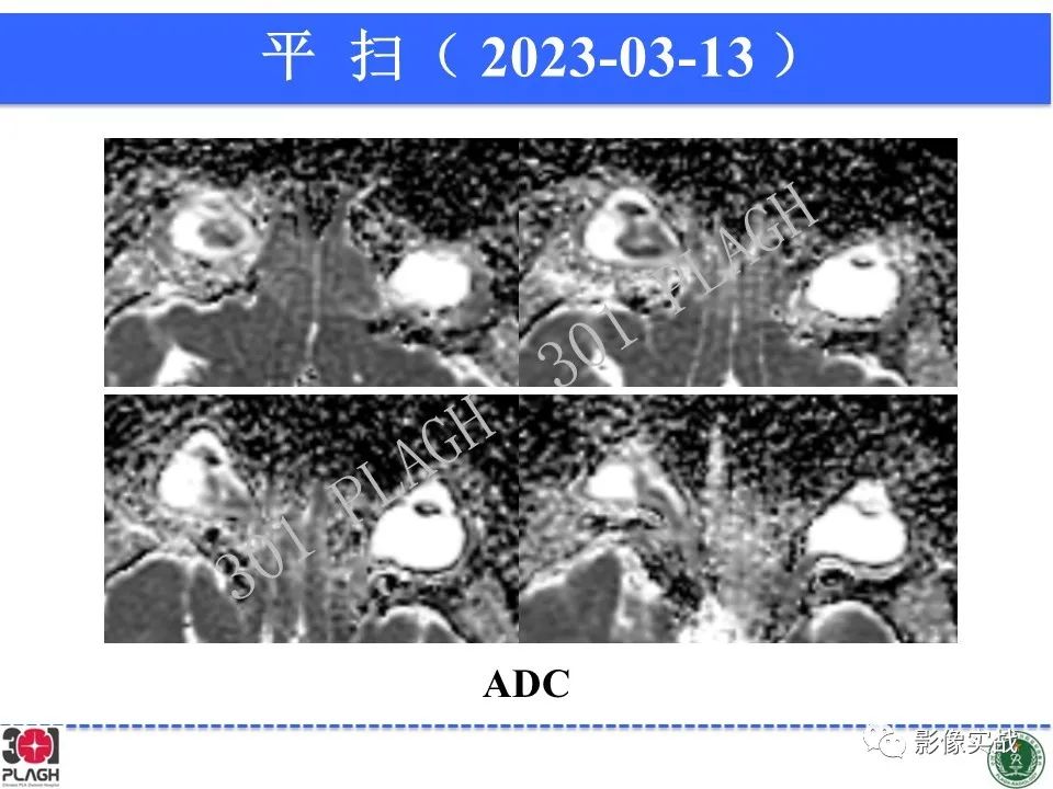 影像PPT - 【病例】视网膜母细胞瘤1例MR影像-8