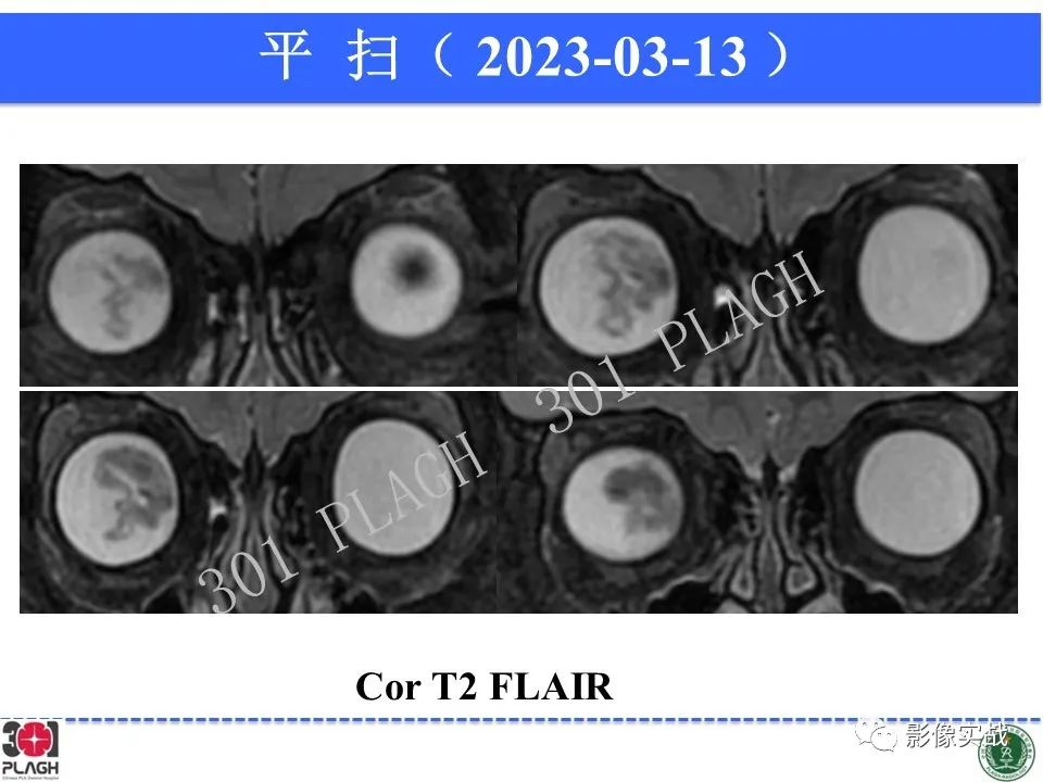 影像PPT - 【病例】视网膜母细胞瘤1例MR影像-9