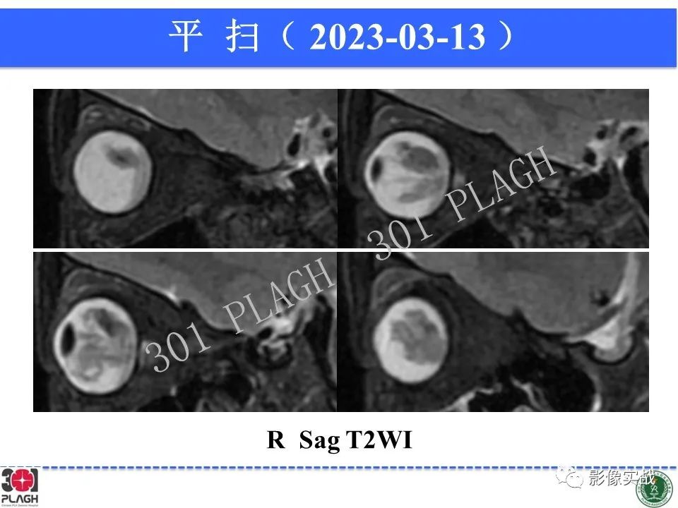 影像PPT - 【病例】视网膜母细胞瘤1例MR影像-10