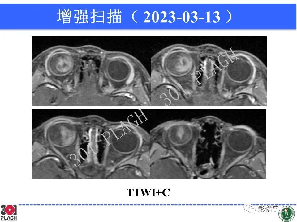 影像PPT - 【病例】视网膜母细胞瘤1例MR影像-11