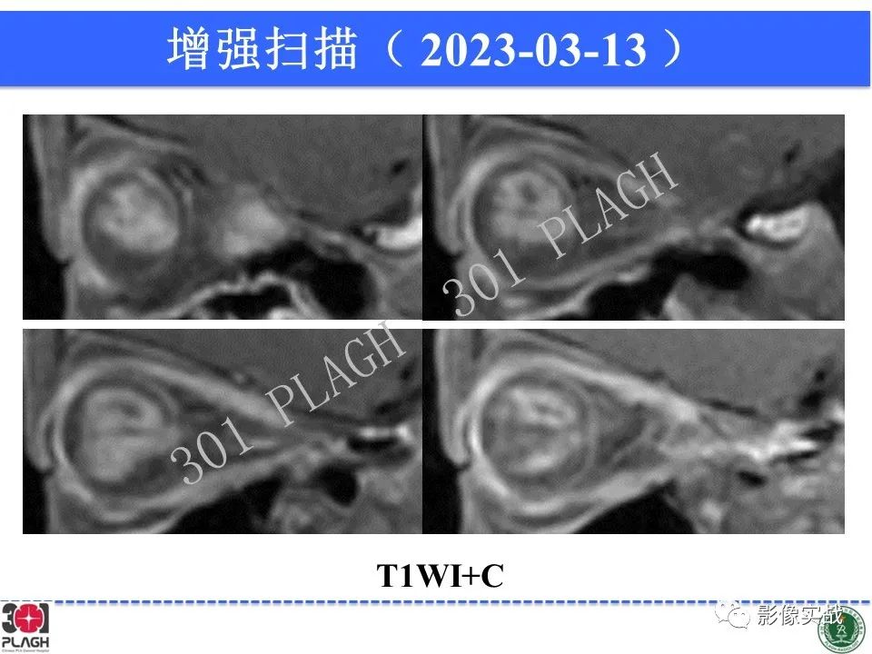 影像PPT - 【病例】视网膜母细胞瘤1例MR影像-13