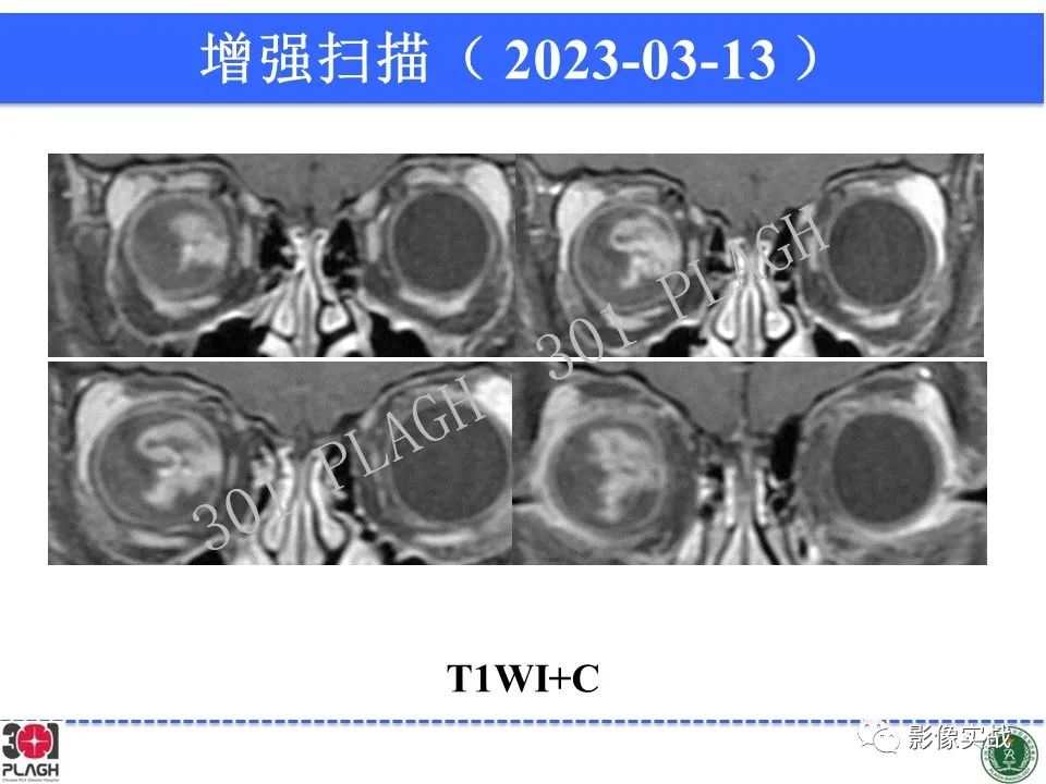 影像PPT - 【病例】视网膜母细胞瘤1例MR影像-12
