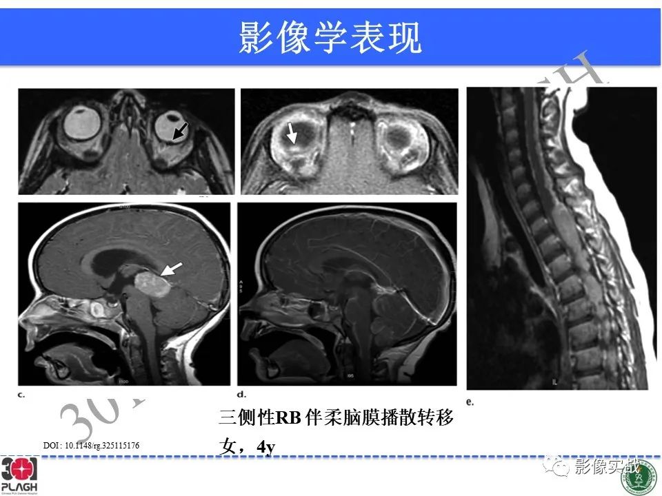 影像PPT - 【病例】视网膜母细胞瘤1例MR影像-21
