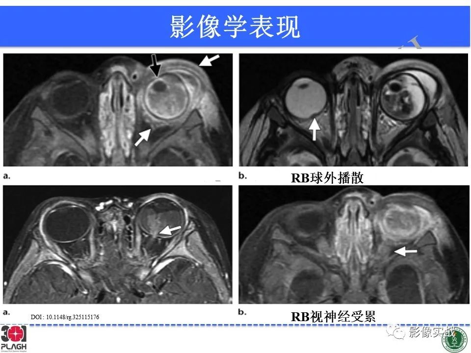 影像PPT - 【病例】视网膜母细胞瘤1例MR影像-22