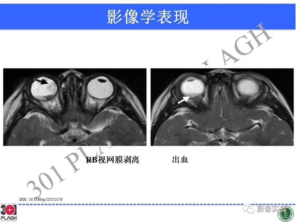 影像PPT - 【病例】视网膜母细胞瘤1例MR影像-23