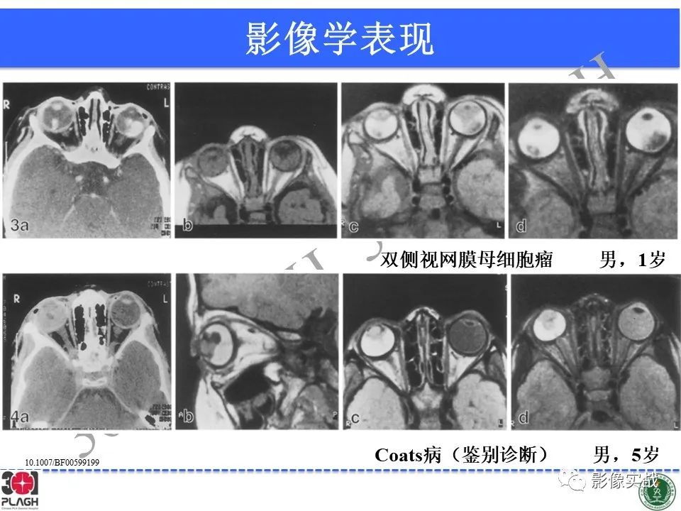 影像PPT - 【病例】视网膜母细胞瘤1例MR影像-24