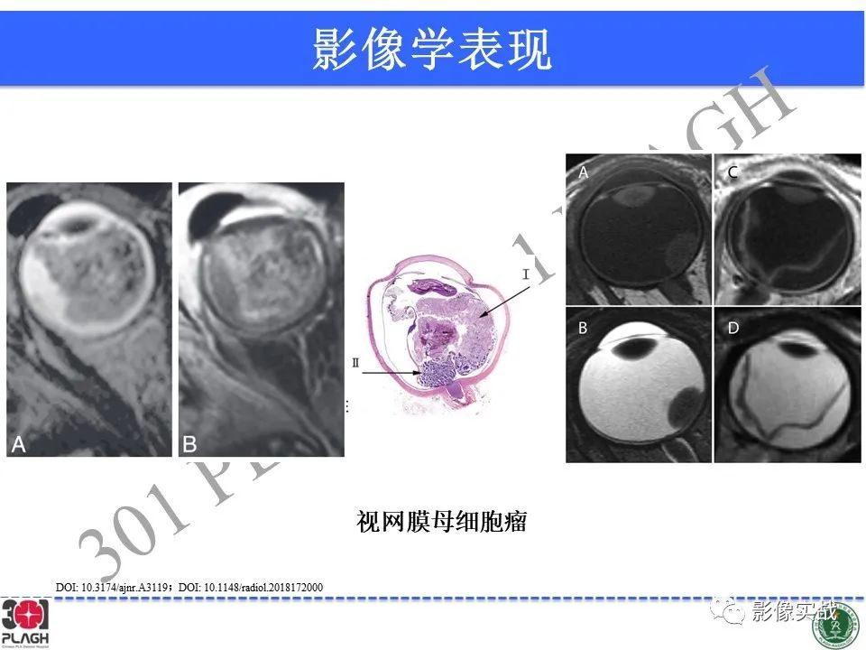 影像PPT - 【病例】视网膜母细胞瘤1例MR影像-25