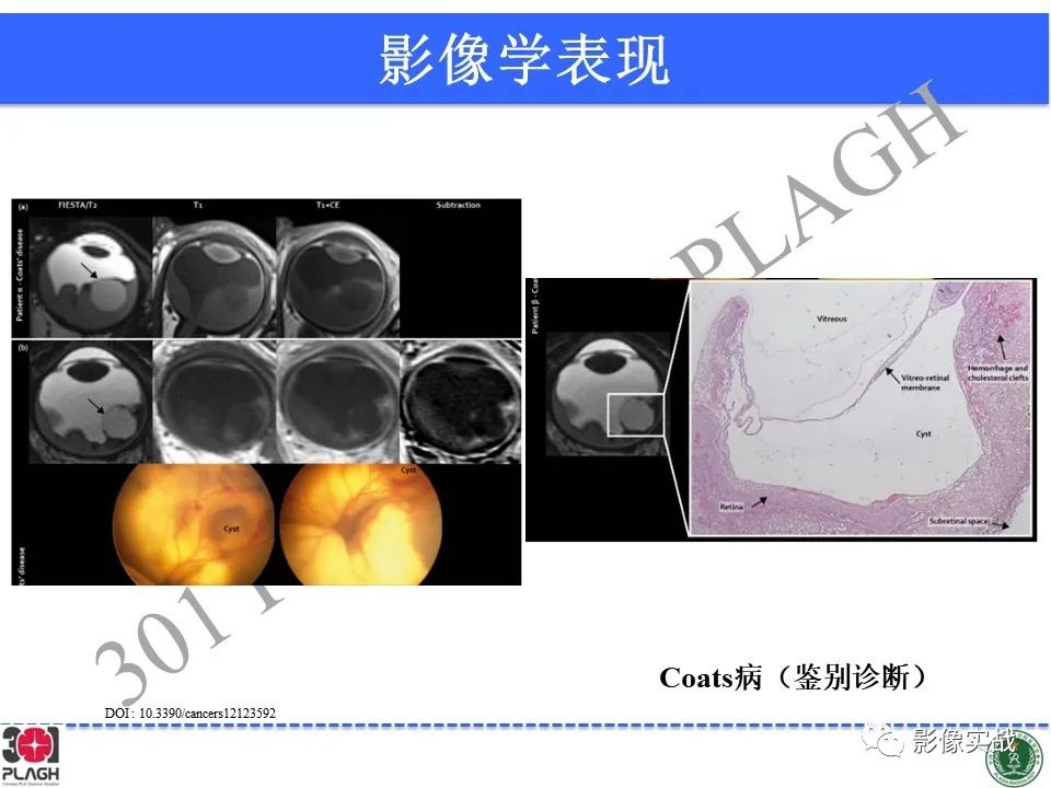 影像PPT - 【病例】视网膜母细胞瘤1例MR影像-26