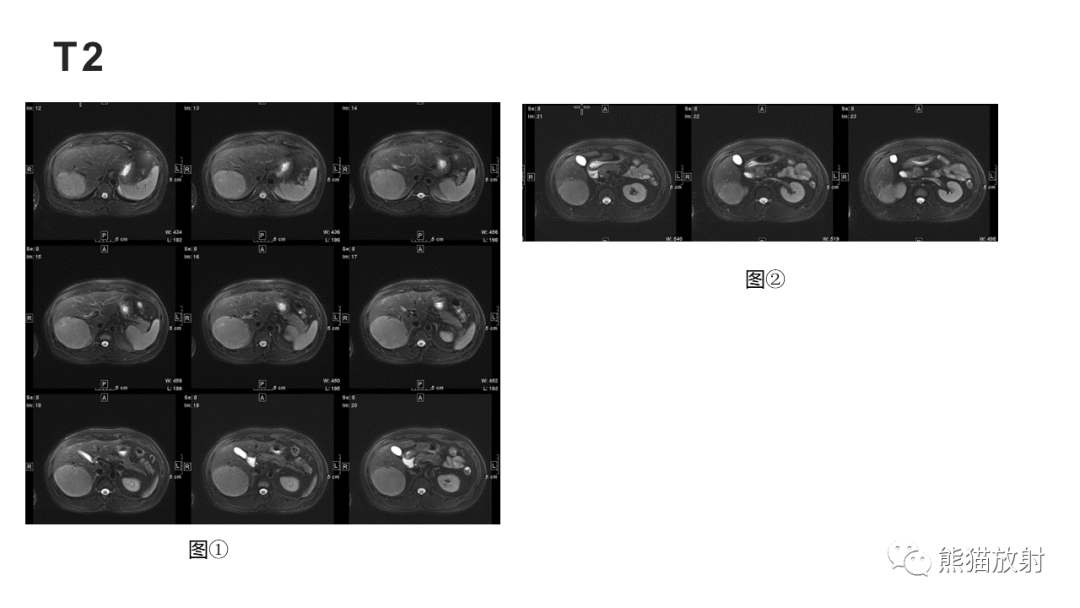 影像PPT - 【病例】肝细胞腺瘤HCA VS 肝脏局灶性结节性增生FNH-4