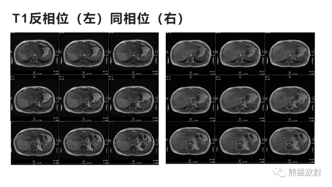 影像PPT - 【病例】肝细胞腺瘤HCA VS 肝脏局灶性结节性增生FNH-5