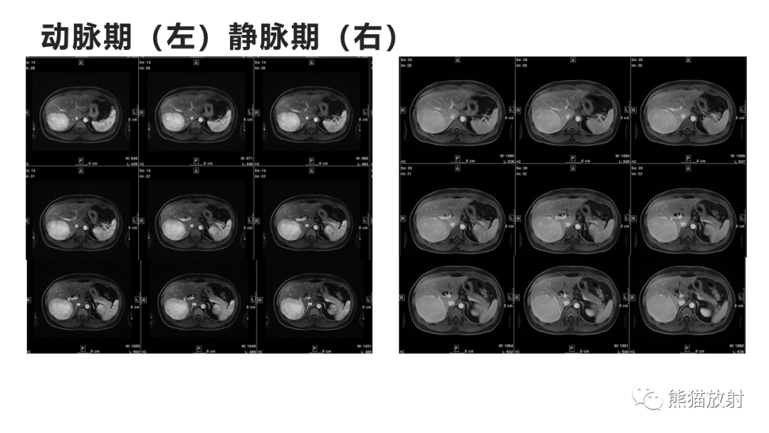 影像PPT - 【病例】肝细胞腺瘤HCA VS 肝脏局灶性结节性增生FNH-6