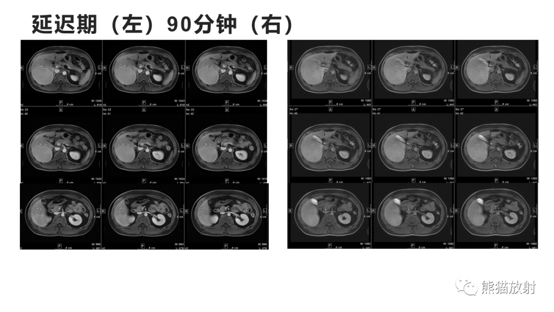 影像PPT - 【病例】肝细胞腺瘤HCA VS 肝脏局灶性结节性增生FNH-7