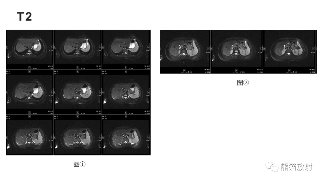 影像PPT - 【病例】肝细胞腺瘤HCA VS 肝脏局灶性结节性增生FNH-11