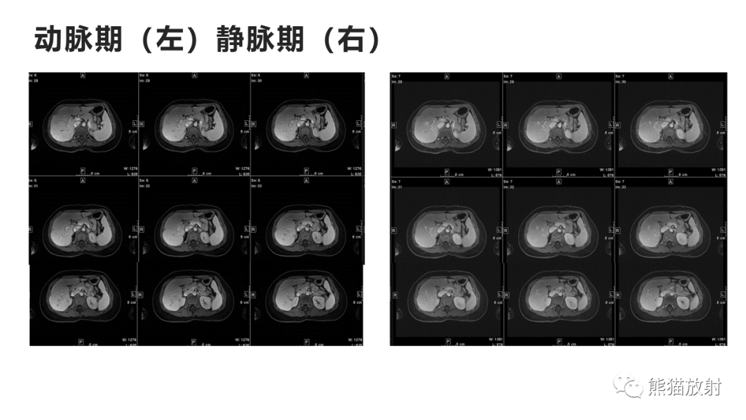 影像PPT - 【病例】肝细胞腺瘤HCA VS 肝脏局灶性结节性增生FNH-12