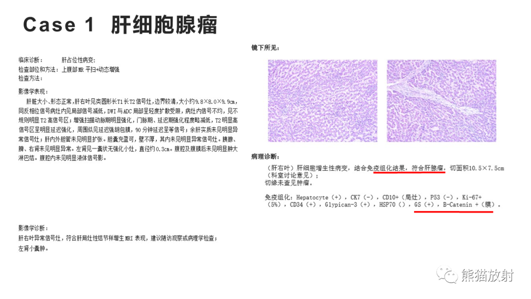 影像PPT - 【病例】肝细胞腺瘤HCA VS 肝脏局灶性结节性增生FNH-15