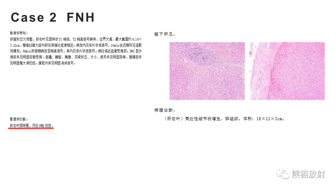 影像PPT - 【病例】肝细胞腺瘤HCA VS 肝脏局灶性结节性增生FNH-16