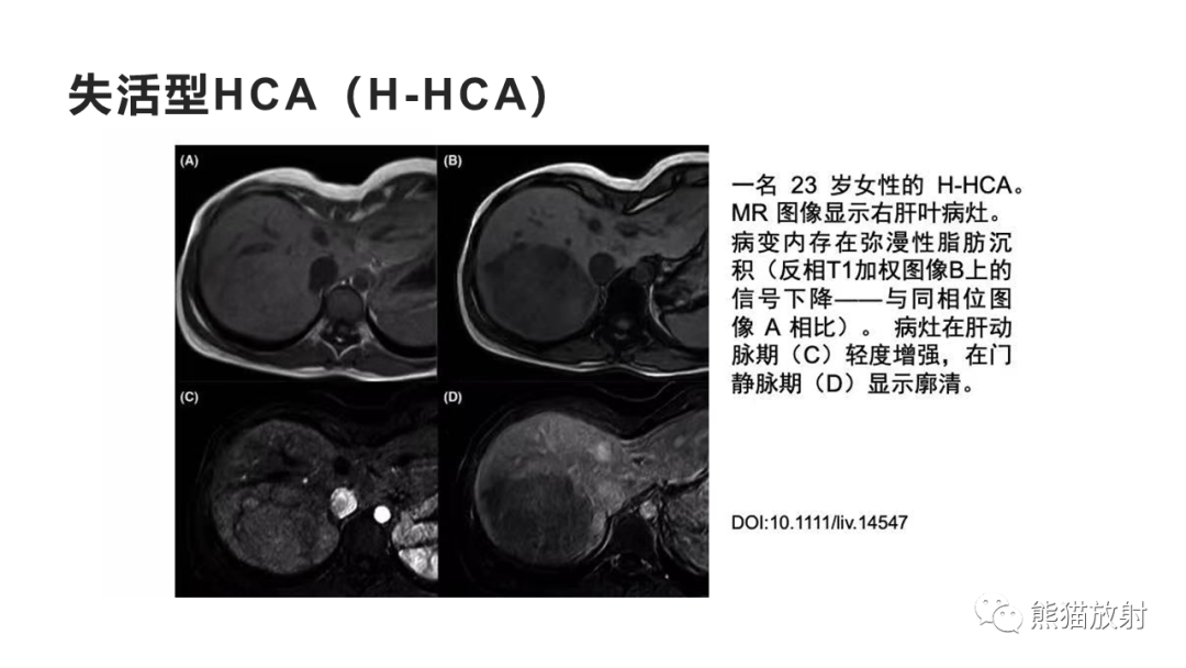 影像PPT - 【病例】肝细胞腺瘤HCA VS 肝脏局灶性结节性增生FNH-21