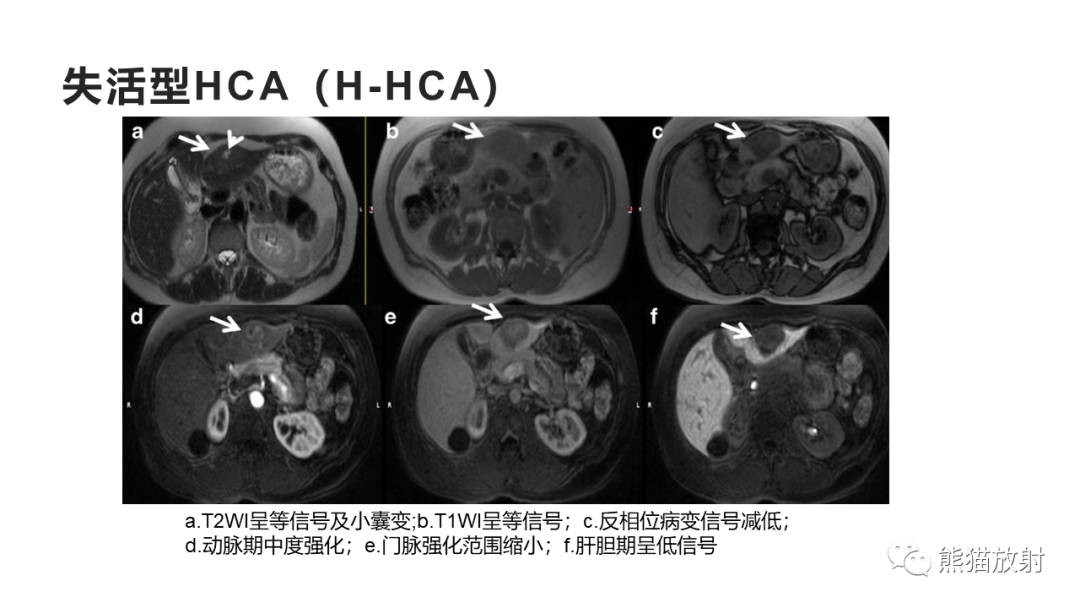 影像PPT - 【病例】肝细胞腺瘤HCA VS 肝脏局灶性结节性增生FNH-22