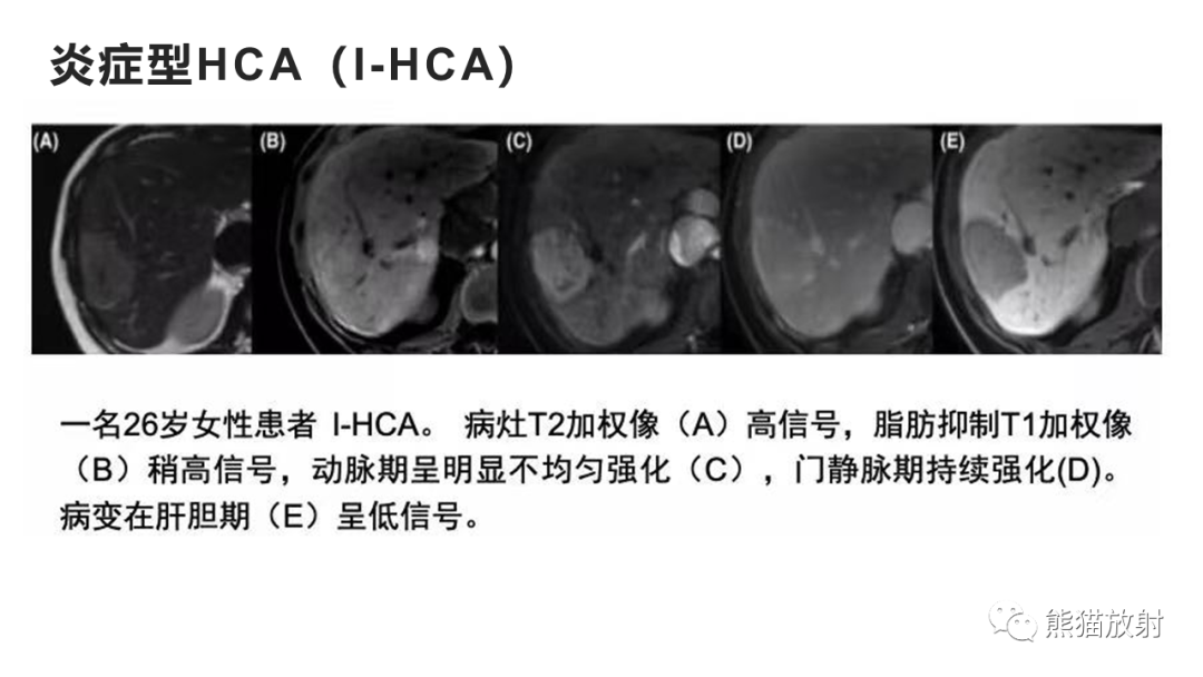 影像PPT - 【病例】肝细胞腺瘤HCA VS 肝脏局灶性结节性增生FNH-24