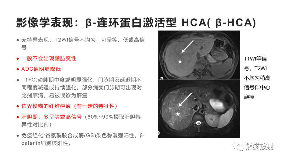影像PPT - 【病例】肝细胞腺瘤HCA VS 肝脏局灶性结节性增生FNH-26