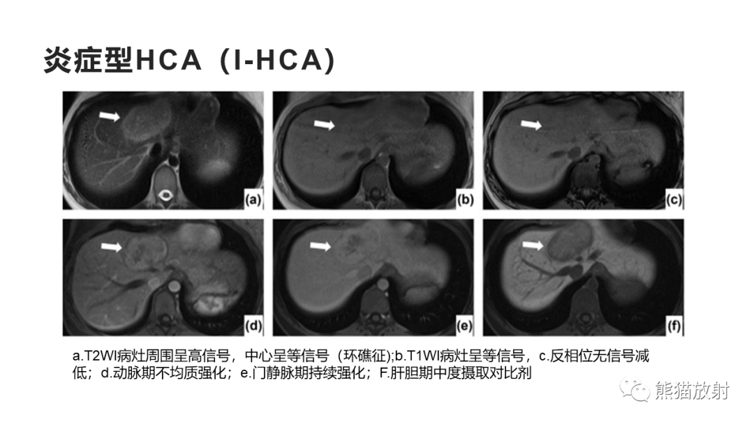 影像PPT - 【病例】肝细胞腺瘤HCA VS 肝脏局灶性结节性增生FNH-25