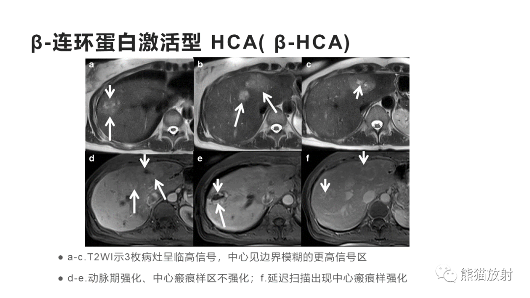 影像PPT - 【病例】肝细胞腺瘤HCA VS 肝脏局灶性结节性增生FNH-27