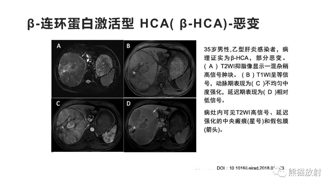 影像PPT - 【病例】肝细胞腺瘤HCA VS 肝脏局灶性结节性增生FNH-28