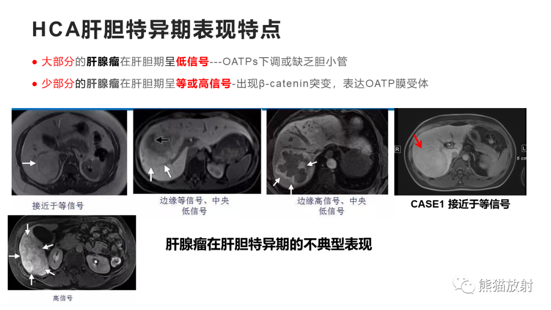 影像PPT - 【病例】肝细胞腺瘤HCA VS 肝脏局灶性结节性增生FNH-30