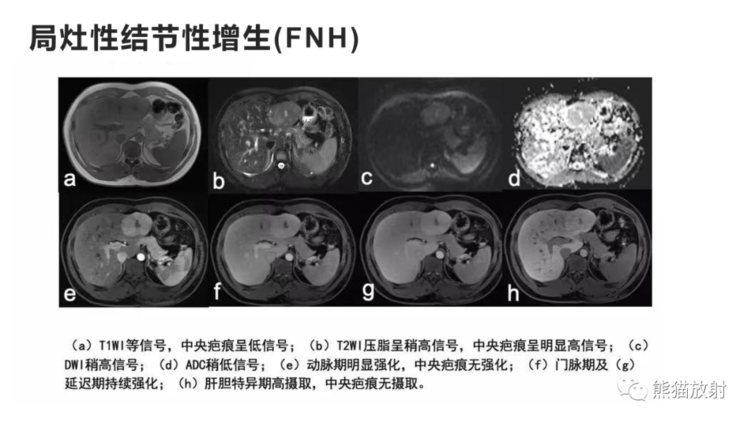 影像PPT - 【病例】肝细胞腺瘤HCA VS 肝脏局灶性结节性增生FNH-33