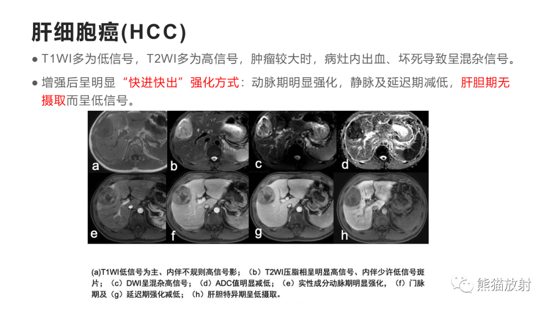 影像PPT - 【病例】肝细胞腺瘤HCA VS 肝脏局灶性结节性增生FNH-34