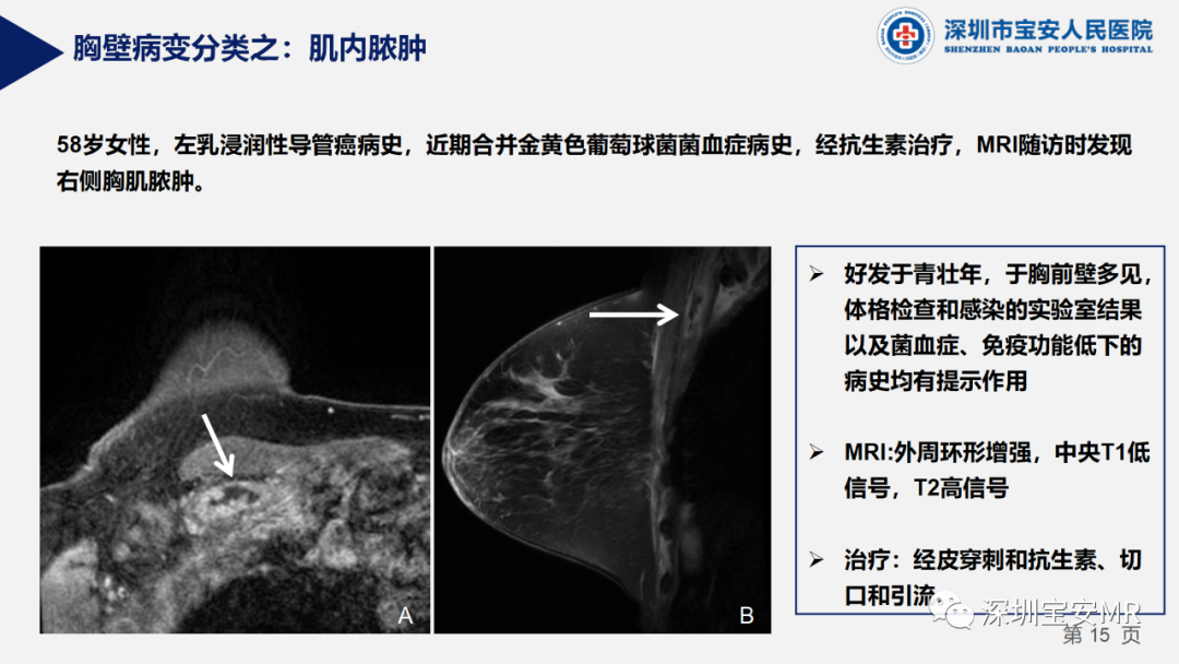 影像PPT - 【PPT】胸壁病变的影像诊断-15