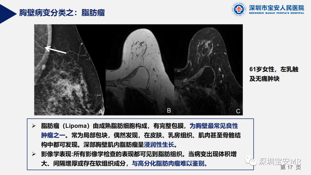 影像PPT - 【PPT】胸壁病变的影像诊断-17